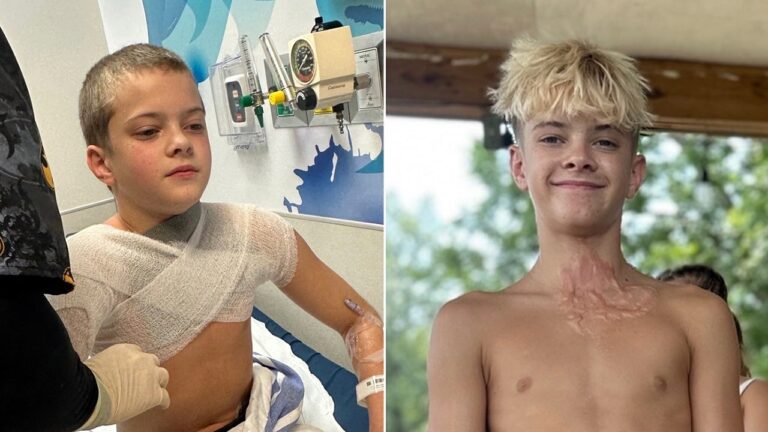 child-suffers-burns.jpg